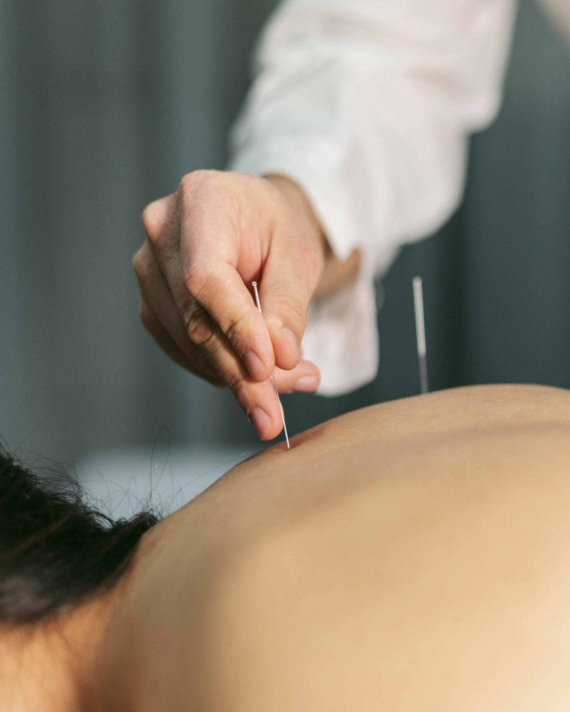 Acupuntura
