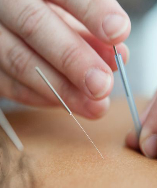 Acupuntura