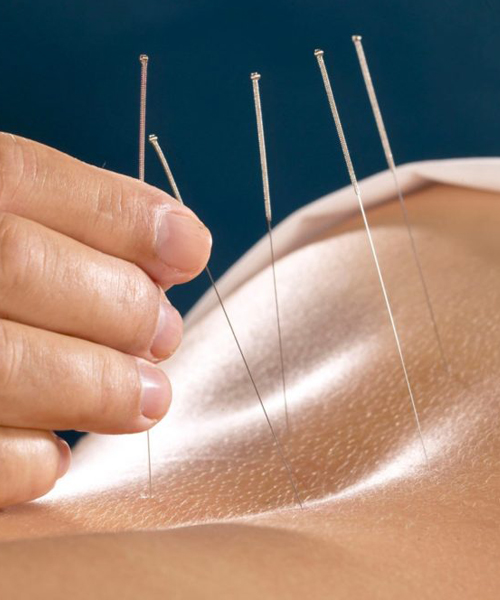 Acupuntura