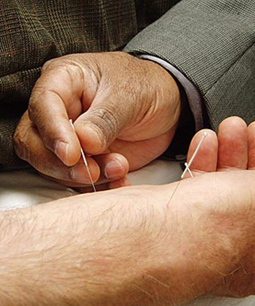 Acupuntura