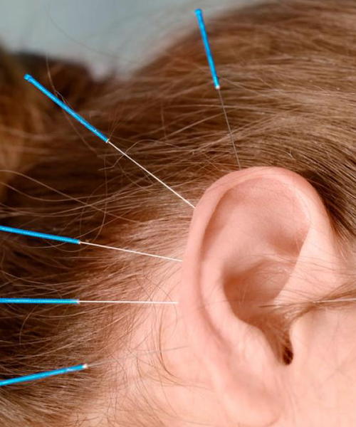 Acupuntura